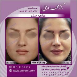 جراحی-بینی-105