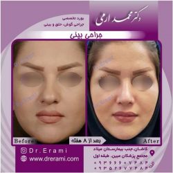 جراحی-بینی-107