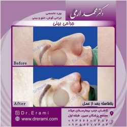 جراحی-بینی-108