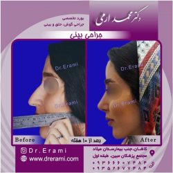 جراحی-بینی-11
