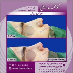 جراحی-بینی-111