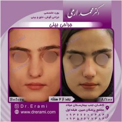 جراحی-بینی-114