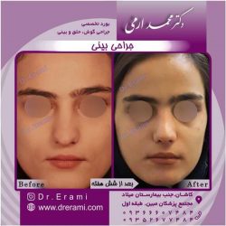 جراحی-بینی-115