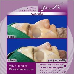 جراحی-بینی-116