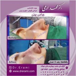 جراحی-بینی-12