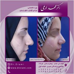 جراحی-بینی-125