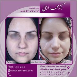 جراحی-بینی-126