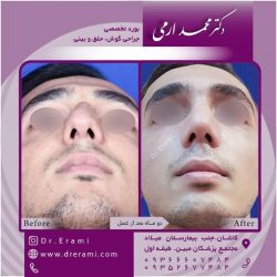 جراحی-بینی-127