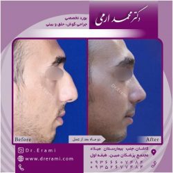جراحی-بینی-128