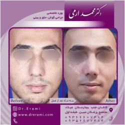 جراحی-بینی-129