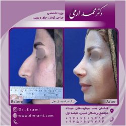 جراحی-بینی-130