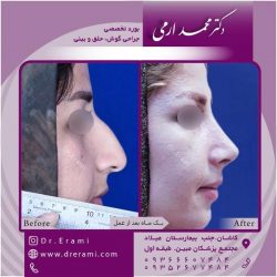 جراحی-بینی-131