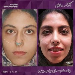 جراحی-بینی-208