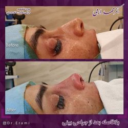 جراحی-بینی-210