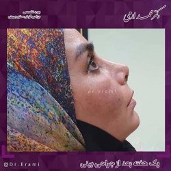 جراحی-بینی-211