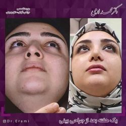 جراحی-بینی-212