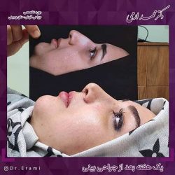 جراحی-بینی-213