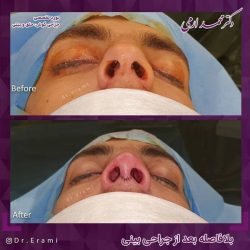 جراحی-بینی-214