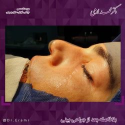 جراحی-بینی-216
