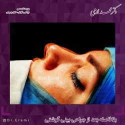 جراحی-بینی-219