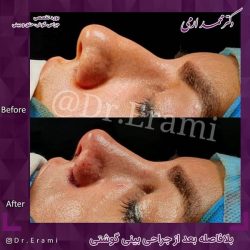 جراحی-بینی-220