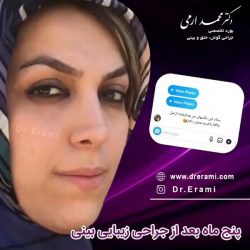 جراحی-بینی-224