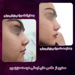 جراحی-بینی-230