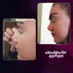 جراحی-بینی-231