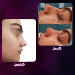 جراحی-بینی-232