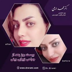 جراحی-بینی-233