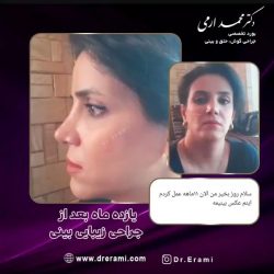 جراحی-بینی-234