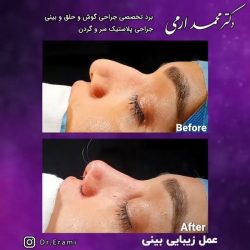 جراحی-بینی-241