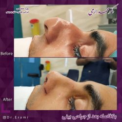 جراحی-بینی-242