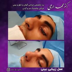 جراحی-بینی-243
