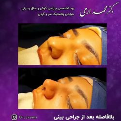 جراحی-بینی-249