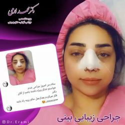 جراحی-بینی-253