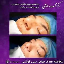 جراحی-بینی-257