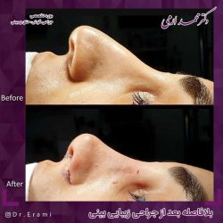 جراحی-بینی-259