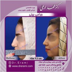 جراحی-بینی-26