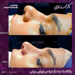 جراحی-بینی-277