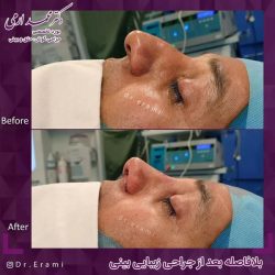 جراحی-بینی-279
