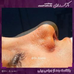 جراحی-بینی-281