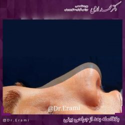 جراحی-بینی-288