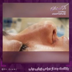 جراحی-بینی-291