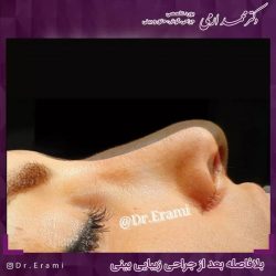 جراحی-بینی-296