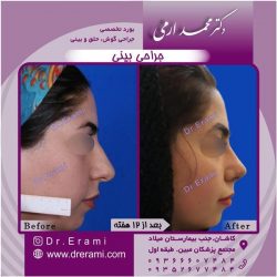 جراحی-بینی-32