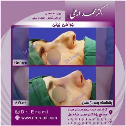 جراحی-بینی-46