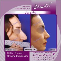 جراحی-بینی-47