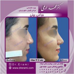 جراحی-بینی-50