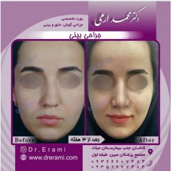 جراحی-بینی-51